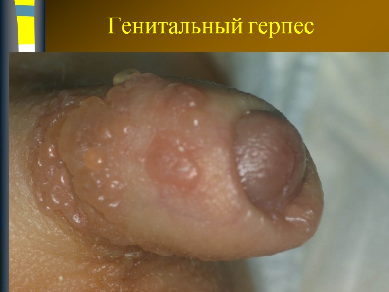 Генитальный герпес